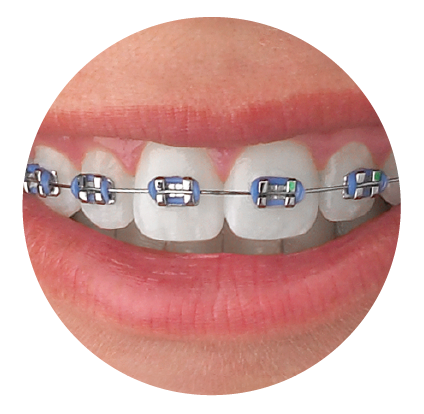 Metal Braces Smile - Murray & Iszkula Orthodontics Erie, PA