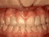 Missing Lateral Incisors After