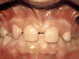 Missing Lateral Incisors Before