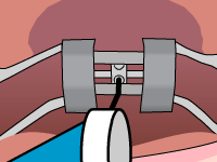 Palatal Expander Step 3