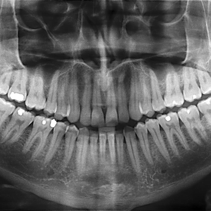 Dental X-Rays:It's Time for your Close Up