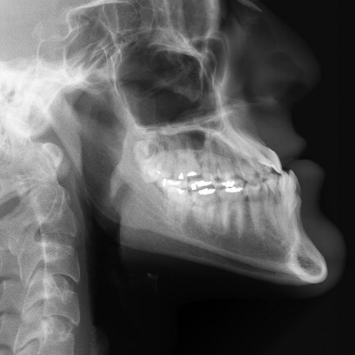 Types of Malocclusions