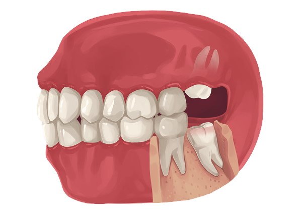 Wisdom Teeth and Braces