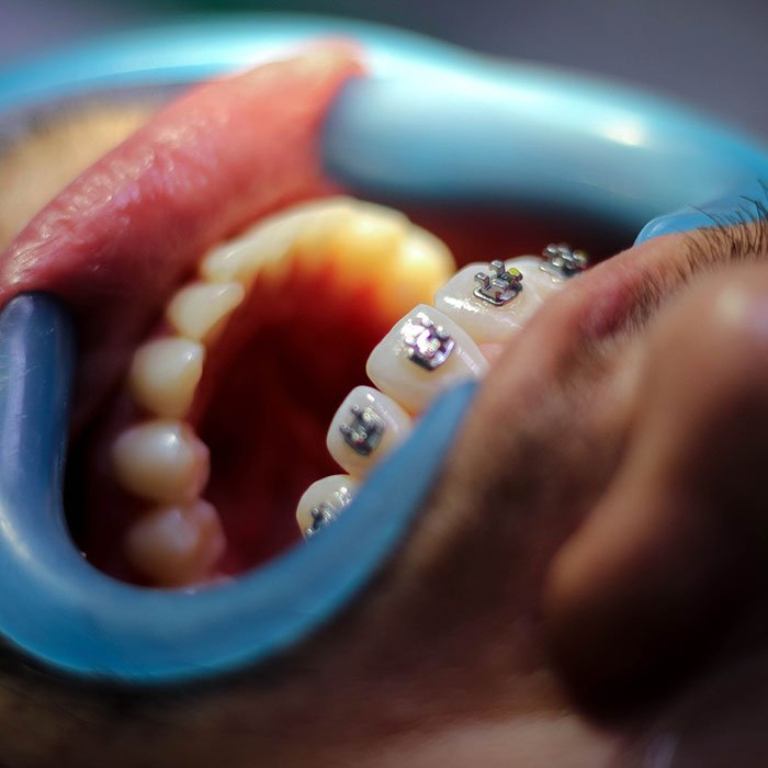 Preparing For Orthodontic Emergencies