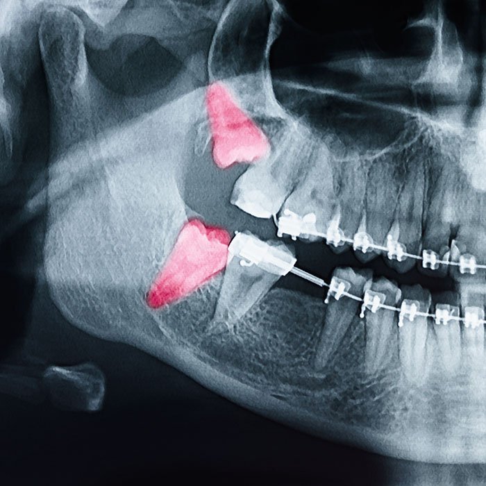 Orthodontic Treatment and Wisdom Teeth