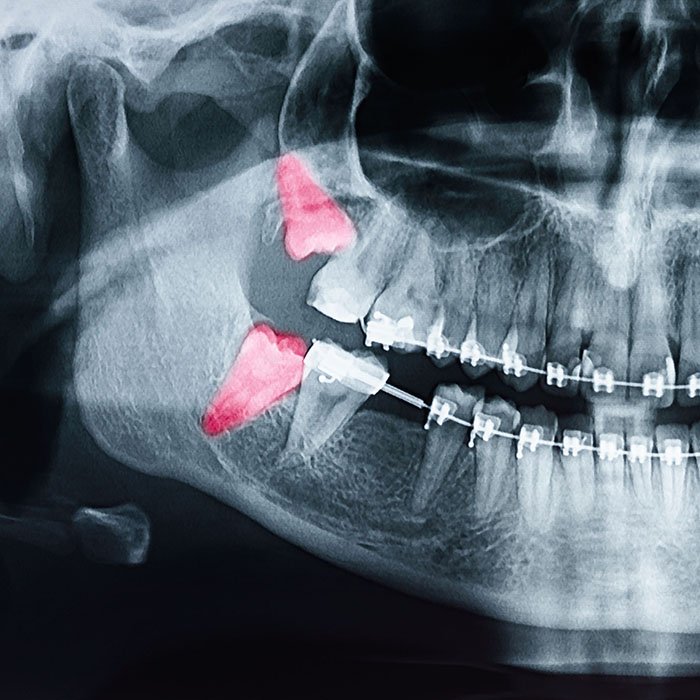 Orthodontics and Wisdom Teeth Removal