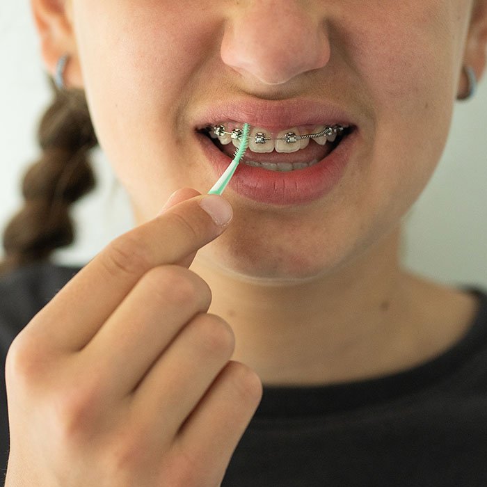Avoiding Stains During Orthodontic Treatment