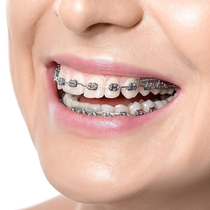 THE MECHANICS OF ORTHODONTIC TREATMENT