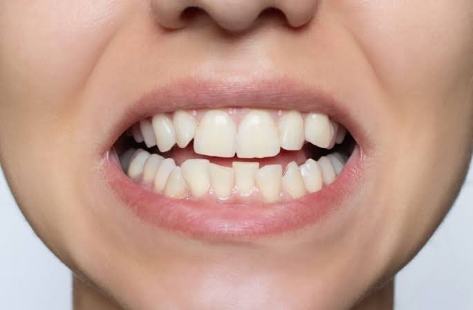 What Causes Teeth to Become Crooked?